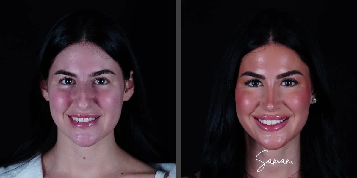 Rhinoplasty + Lip Lift result — Saman MD, New York