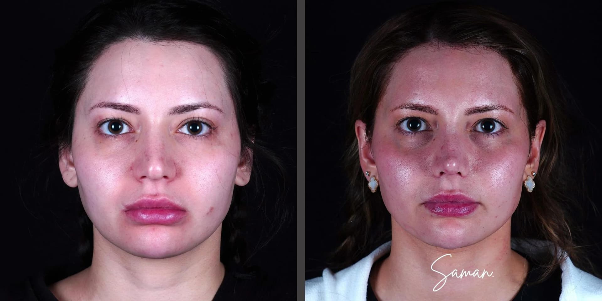 Revision Rhinoplasty result — Saman MD, New York